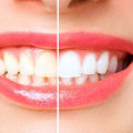 DIY Teeth Whitening Treatments: Natural Ingredients Beauty Hacks