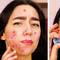 7 Beauty Hacks to Get Rid of Acne and Have Clear Skin
