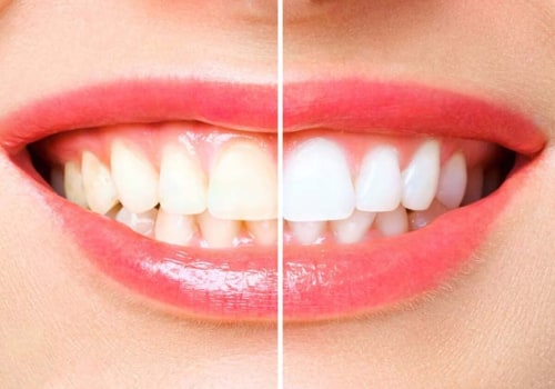 DIY Teeth Whitening Treatments: Natural Ingredients Beauty Hacks