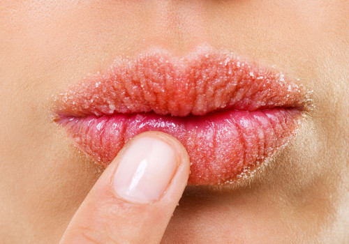 The Ultimate Guide to Avoiding Chapped Lips: Beauty and Health Tips from Dermatologists