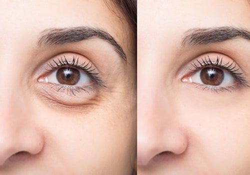 7 Simple Beauty Hacks to Get Rid of Puffy Eyes