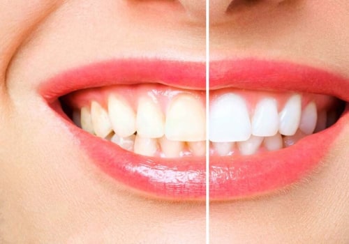 DIY Teeth Whitening Treatments with Natural Ingredients: Beauty Hacks